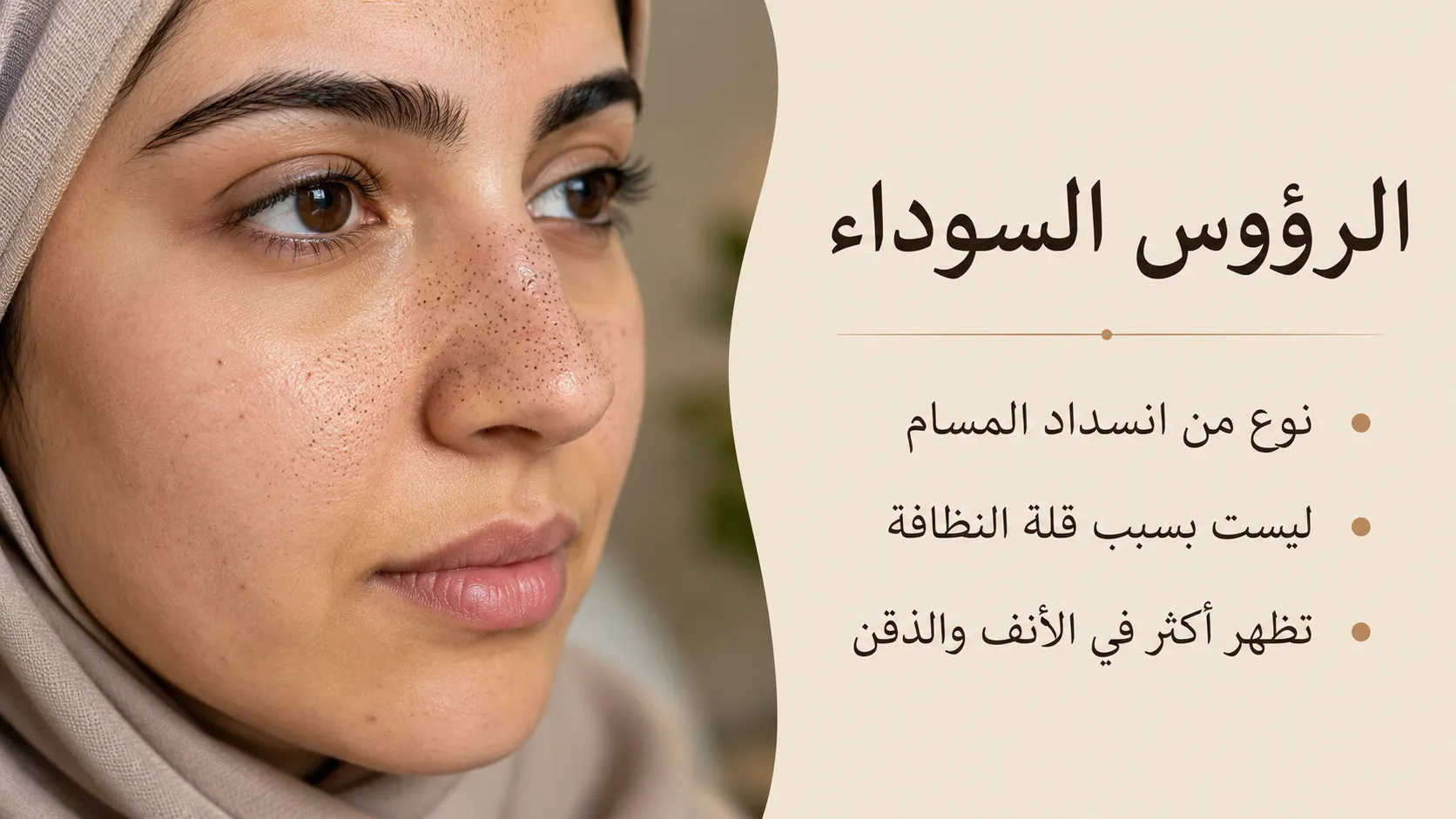 الرؤوس السوداء: أسبابها وطرق إزالتها والوقاية من عودتها 4 الرؤوس السوداء على الأنف والخدين لدى امرأة عربية